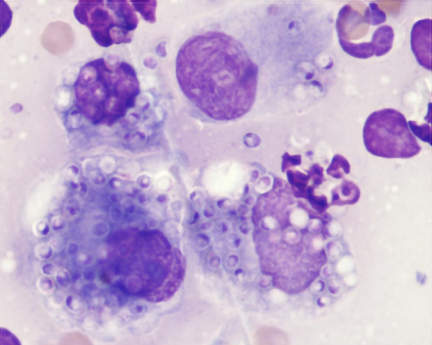 A photo of Histoplasma yeasts seen mostly within macrophages.