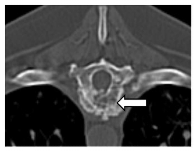 A transverse plane CT image of the osteolytic and proliferative lesion (white arrow) in the ninth thoracic vertebrae caused by an invasive IFI.