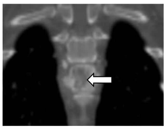 A dorsal plane CT image of the osteolytic and proliferative lesion (white arrow) in the ninth thoracic vertebrae caused by an IFI.