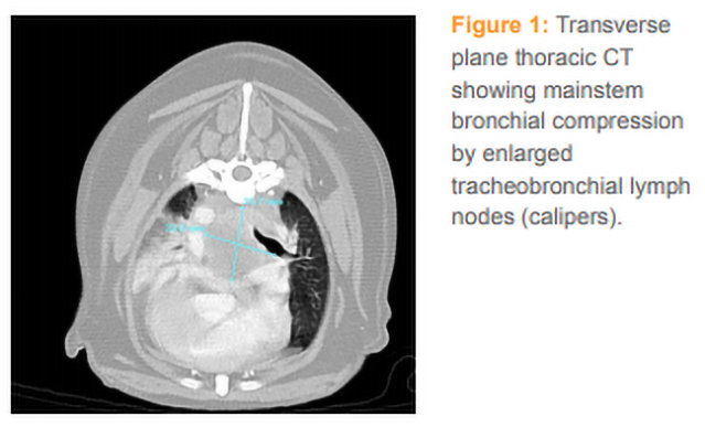 A picture of a CT showing mainstem bronchial compression by enlarged tracheobronchial lymph nodes calipers.