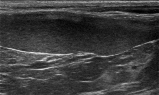 An ultrasound image showing a large hypoechoic spleen with mottle echotexture in a cat with histoplasmosis